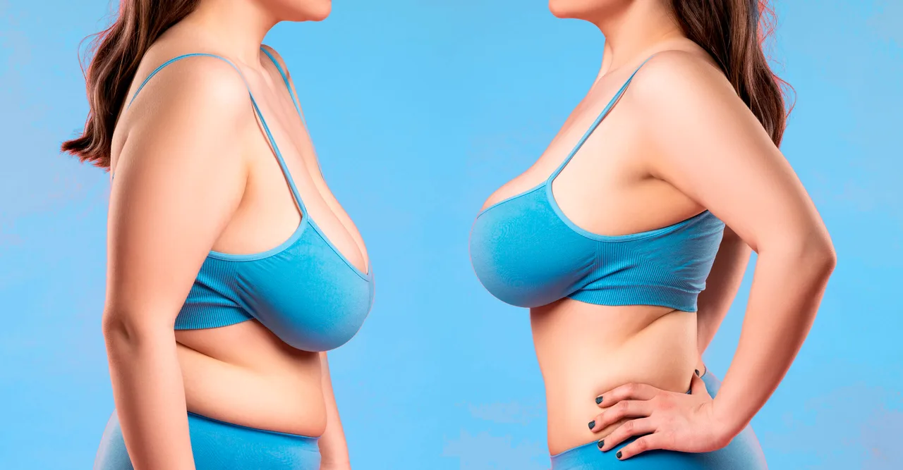 Mamoplastia de redução